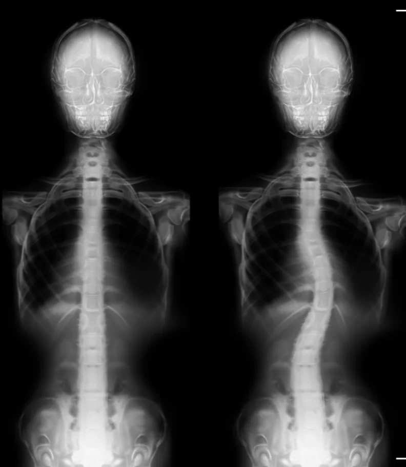 Scoliosis Clive